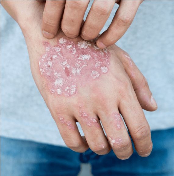 Skin Diseases Treatment